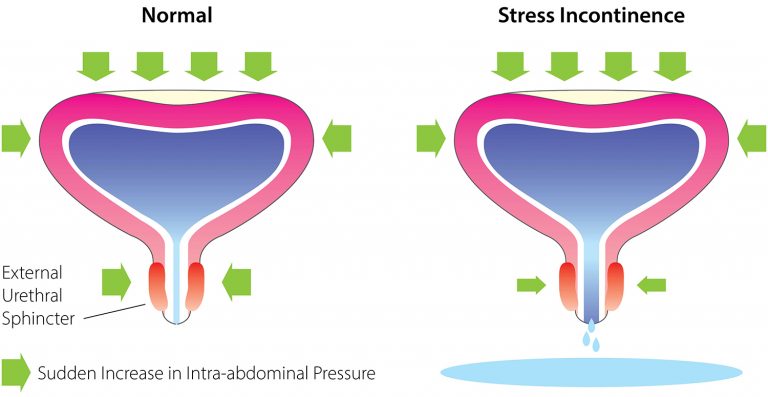 What Is Treatment For Stress Incontinence