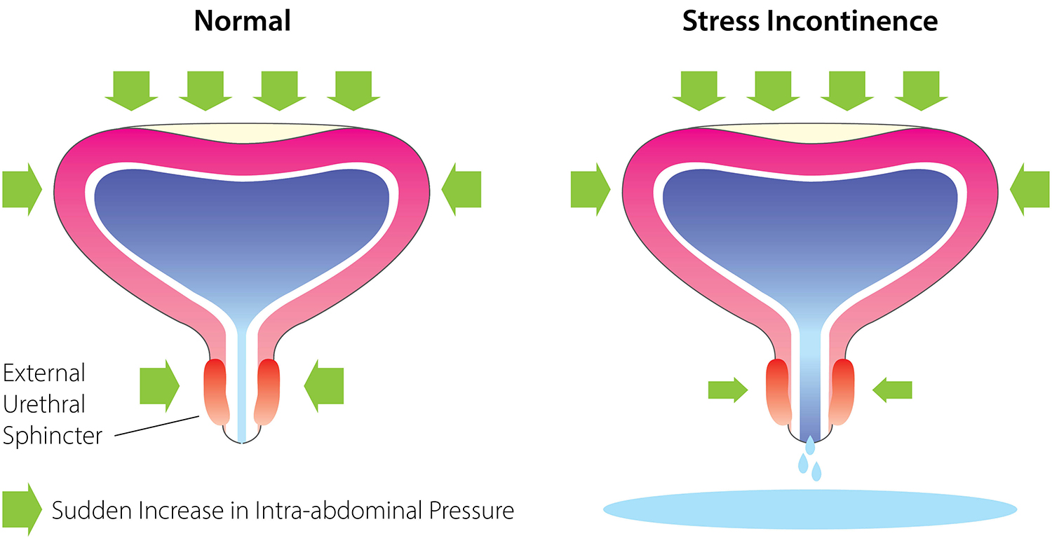 Physiotherapy in Women with Urinary Incontinence